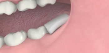 ผ่าฟันคุด ถอนฟันคุด แผลหายไว ปลอดภัย ไม่ติดเชื้อ - Tdh Dental