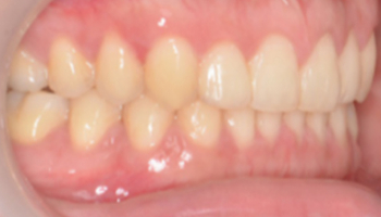 ตัวอย่างการรักษาจัดฟันแบบใส Invisalign รีวิวจัดฟันใส
