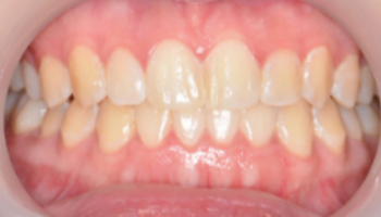 ตัวอย่างการรักษาจัดฟันแบบใส Invisalign รีวิวจัดฟันใส