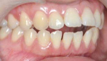 ตัวอย่างการรักษาจัดฟันแบบใส Invisalign