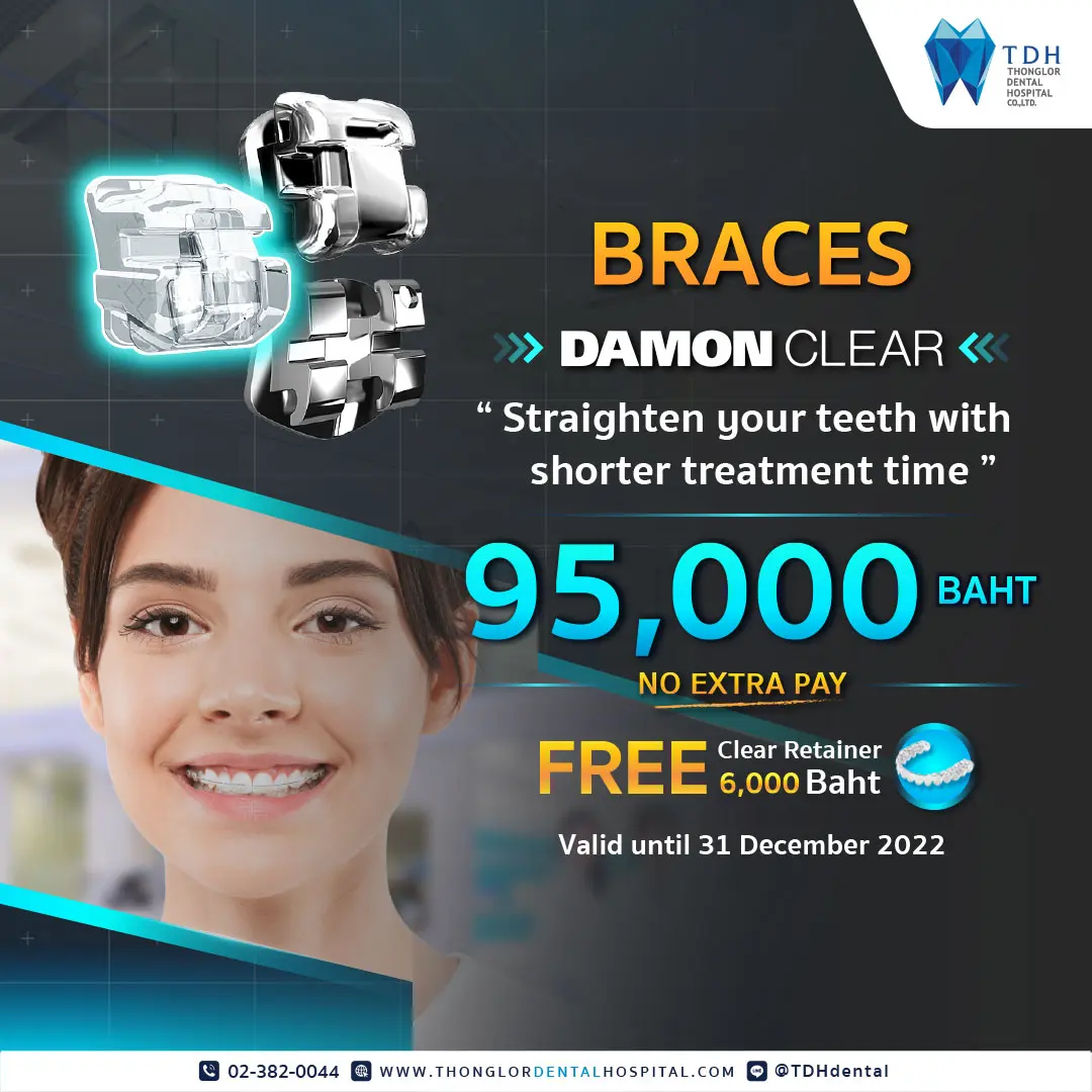 Promotion Damon Clear Braces