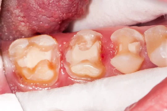 ใส่ครอบฟัน Dental Crown