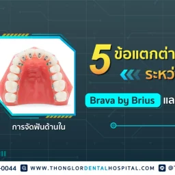 จัดฟัน Brava by Brius กับจัดฟันด้านใน