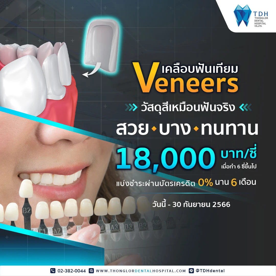 โปรโมชั่นวีเนียร์ veneer เคลือบฟันเทียม 2566 ราคา 18,000 บาท
