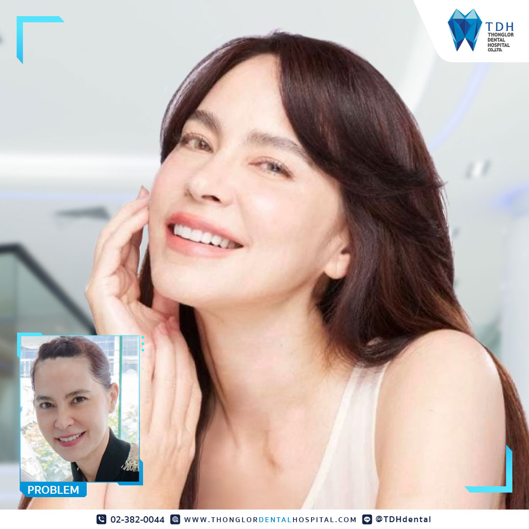 วีเนียร์