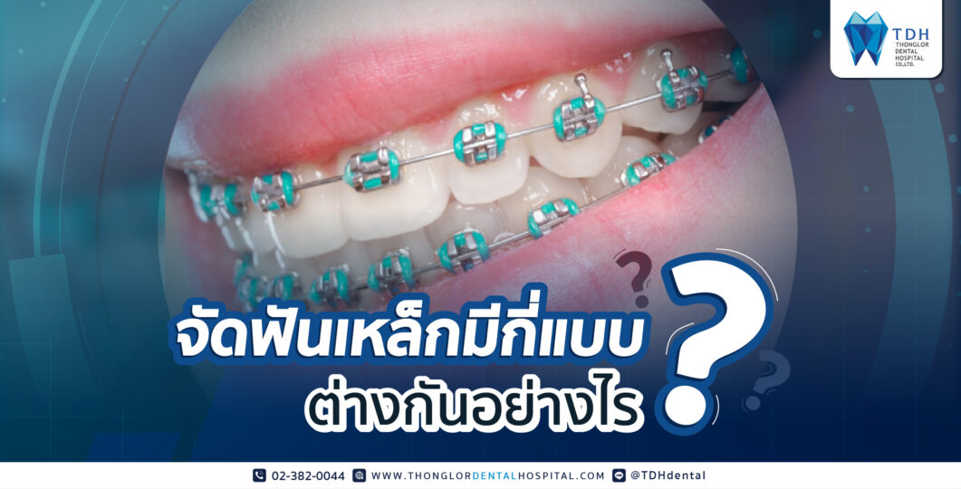 จัดฟันเหล็กมีกี่แบบ ต่างกันอย่างไร