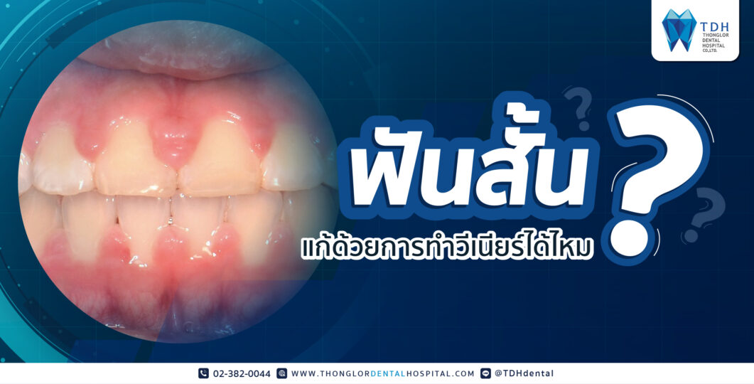 ฟันสั้นแก้ด้วยการทำวีเนียร์ได้ไหม