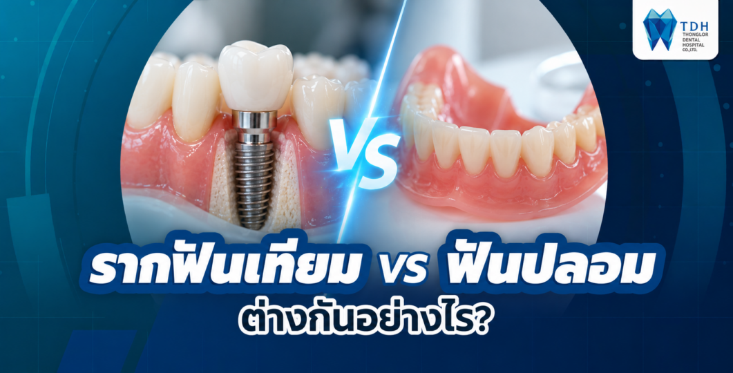 เปรียบเทียบรากฟันเทียมและฟันปลอม ความแตกต่างของโครงสร้าง การยึดติด และการทดแทนฟันธรรมชาติ