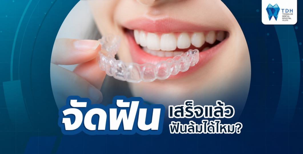 จัดฟันเสร็จแล้วฟันล้มและเคลื่อนตำแหน่ง เปรียบเทียบฟันเรียงตัวหลังจัดฟันกับฟันที่กลับมาซ้อนเก