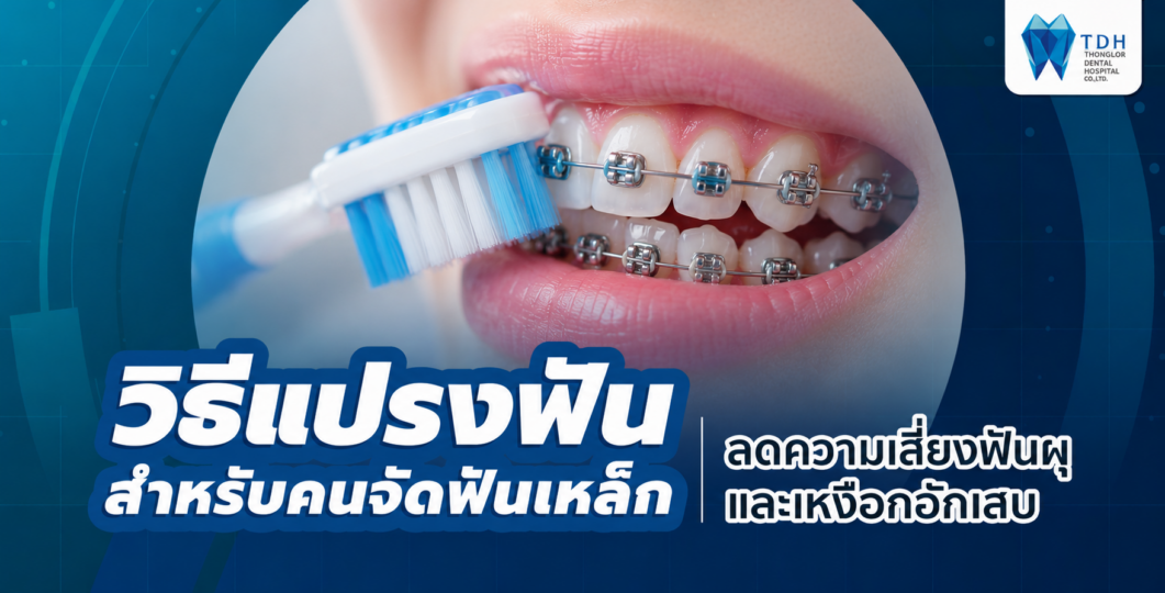 วิธีแปรงฟันสำหรับคนจัดฟันเหล็ก ทำความสะอาดแบร็กเก็ตและลวดจัดฟันด้วยแปรงขนนุ่มและแปรงซอกฟัน