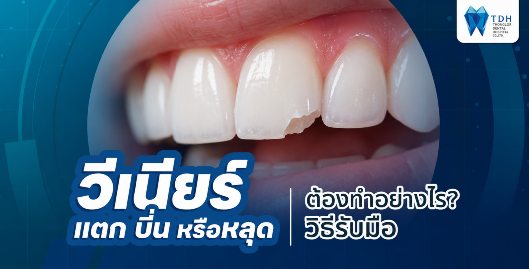 วีเนียร์แตก บิ่น หรือหลุดจากฟัน พร้อมแนวทางรับมือและซ่อมแซมวีเนียร์